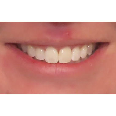 invisalign after evansdale family dentistry